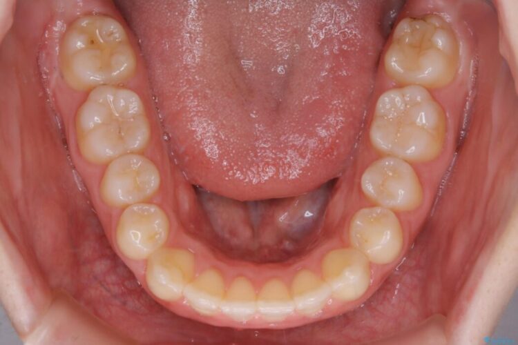 【20代女性】前歯が噛み合わない!開咬（オープンバイト）の矯正治療 治療後画像