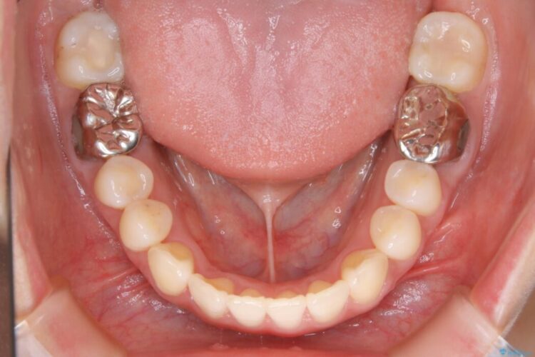 【20代女性】隠れた前歯とガタつきをきれいな歯列弓へ 治療後画像