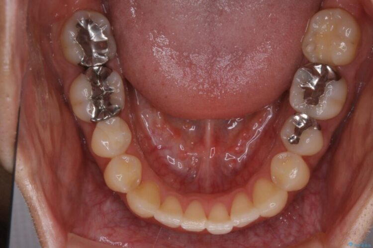 【20代男性】出っ歯をインビザラインで矯正治療 治療後画像