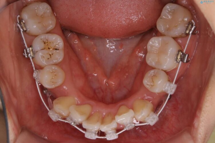 【20代女性】抜歯ワイヤー矯正で八重歯がスッキリ 治療途中画像