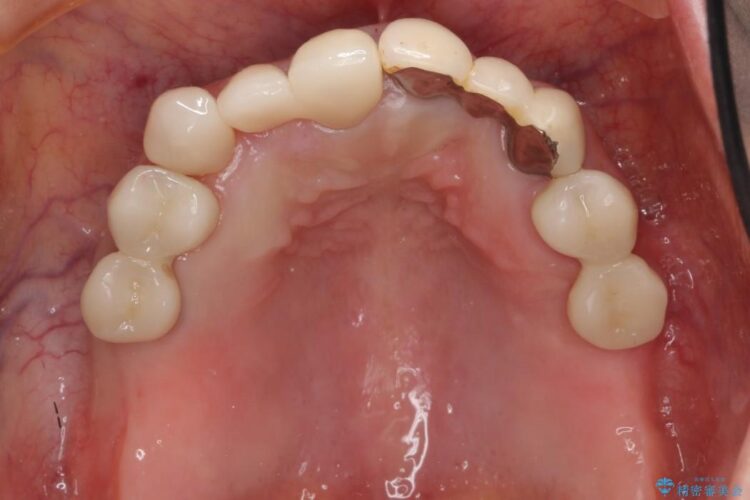 【40代女性】前歯のかぶせ物をセラミックでやりなおす 治療後画像