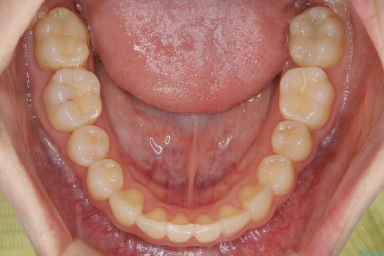 【20代女性】ブライダルに向けた矯正できれいなスマイルラインへ 治療後画像