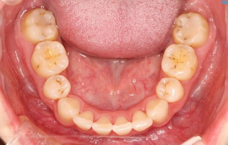 【20代女性】出っ歯の矯正 治療例 治療後画像