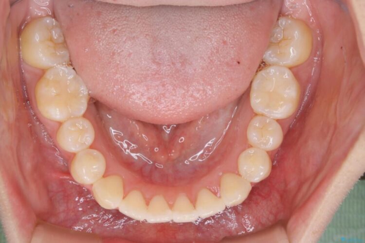 【20代女性】前歯の真ん中（正中）のズレとガタつきを効率よく矯正する 治療後画像