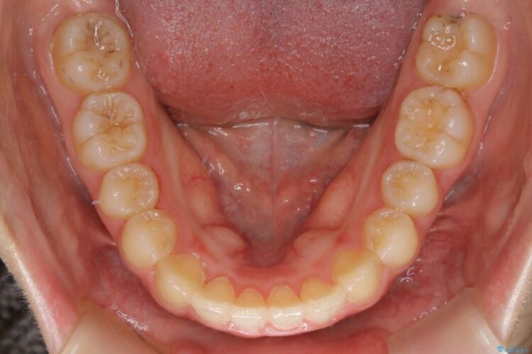 【10代女性】すきっ歯（正中離開）のインビザライン治療 治療後画像