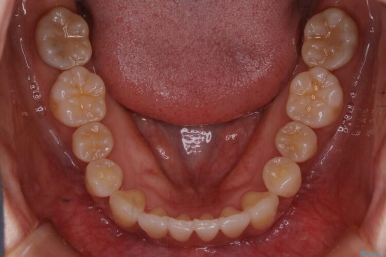 【20代女性】抜歯無しで前歯のがたがたを改善する 治療後画像