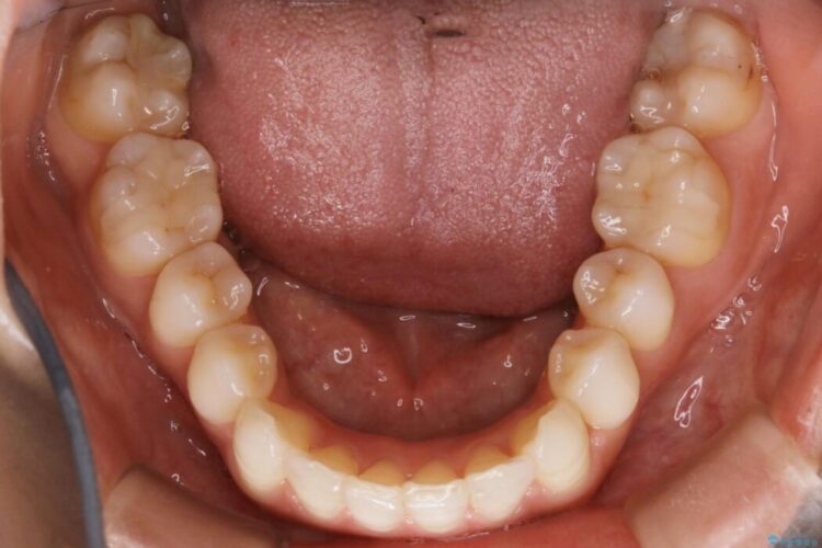 【30代女性】噛み合わせのズレを解消する 治療後画像