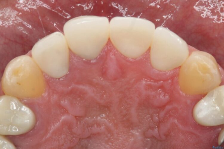 【50代男性】前歯の被せ物を新しく 治療後画像