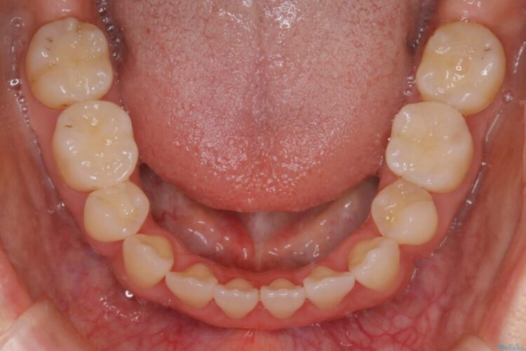 【30代女性】インビザラインで抜歯矯正 治療後画像