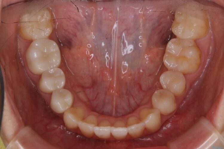 【20代女性】非抜歯で歯列をコンパクトに 治療後画像