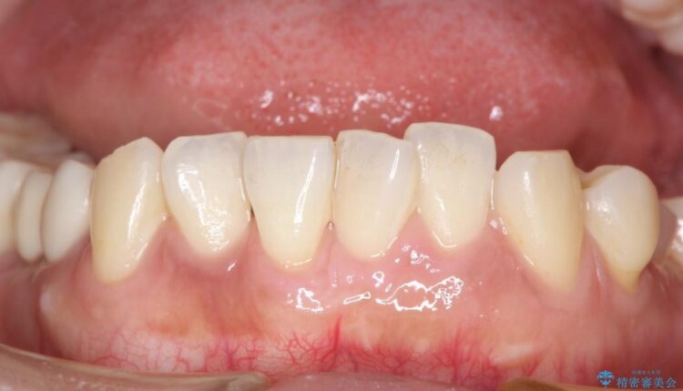 【10代女性】下顎前歯の歯ぐき再生 治療後画像