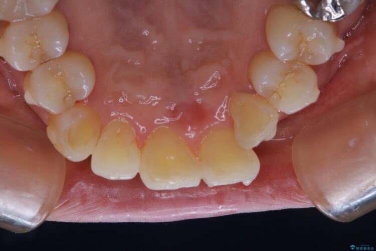 【40代女性】インビザライン治療中のクリーニング 治療後画像