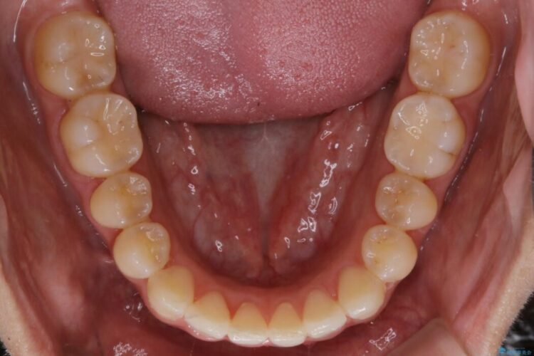 【20代女性】軽度の反対咬合を部分矯正でなおす 治療後画像