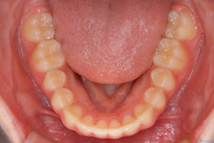 【10代女性】歯並びを整えて自信が持てる素敵な笑顔に 治療後画像