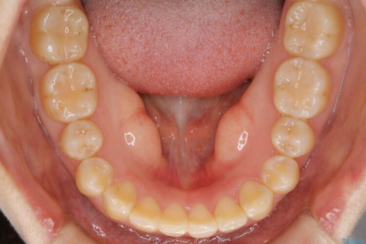 【30代女性】歯を長持ちさせるための咬合調整 治療後画像