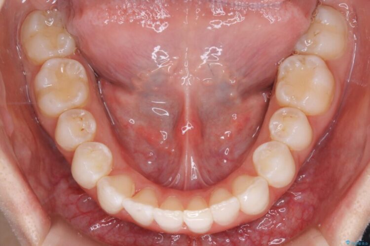 【20代女性】歯軸傾斜を改善して噛み合わせを正しくする 治療後画像