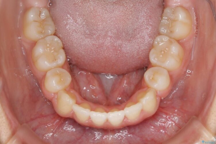 【20代女性】口元を引っ込めたい Eラインの改善 治療後画像