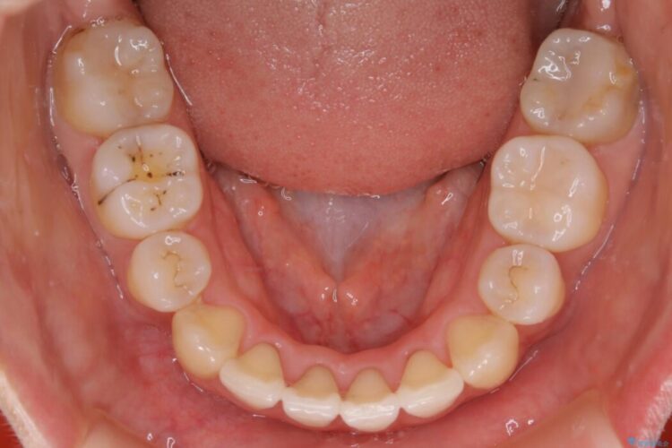 【20代女性】抜歯ワイヤー矯正で八重歯がスッキリ 治療後画像