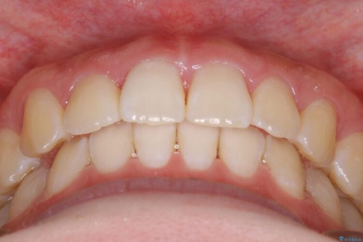 【20代女性】噛み合わせのズレからくるガタついた歯列をインビザライン矯正治療 治療後画像