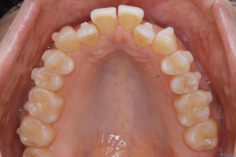 【30代女性】短期間で非抜歯による反対咬合(受け口)の改善 治療途中画像