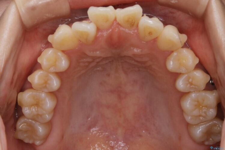 【20代女性】抜歯無しで前歯のがたがたを改善する 治療途中画像