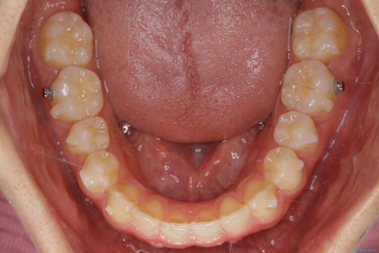 【20代女性】噛み合わせの歪みを超短期間でインビザライン治療 治療途中画像
