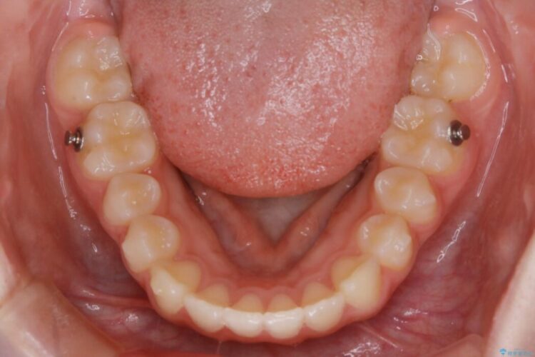 【10代女性】歯並びを整えて自信が持てる素敵な笑顔に 治療途中画像