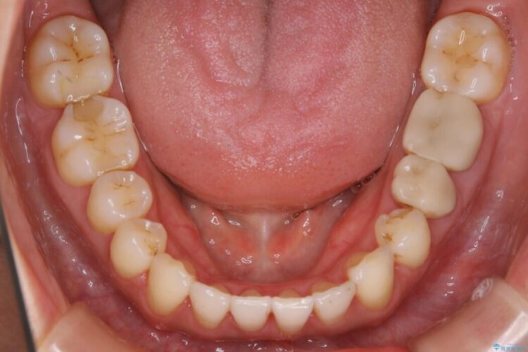 【30代女性】非抜歯で噛み合わせとガタつきの改善 治療後画像