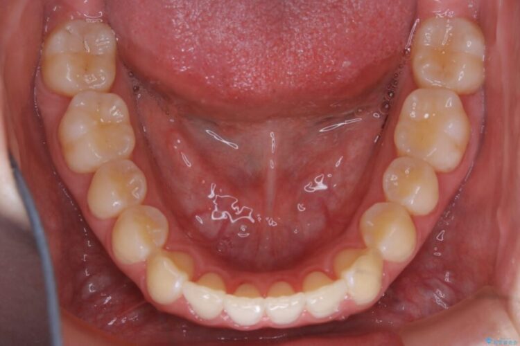 【20代女性】噛み合わせのズレからくるガタついた歯列をインビザライン矯正治療 治療後画像